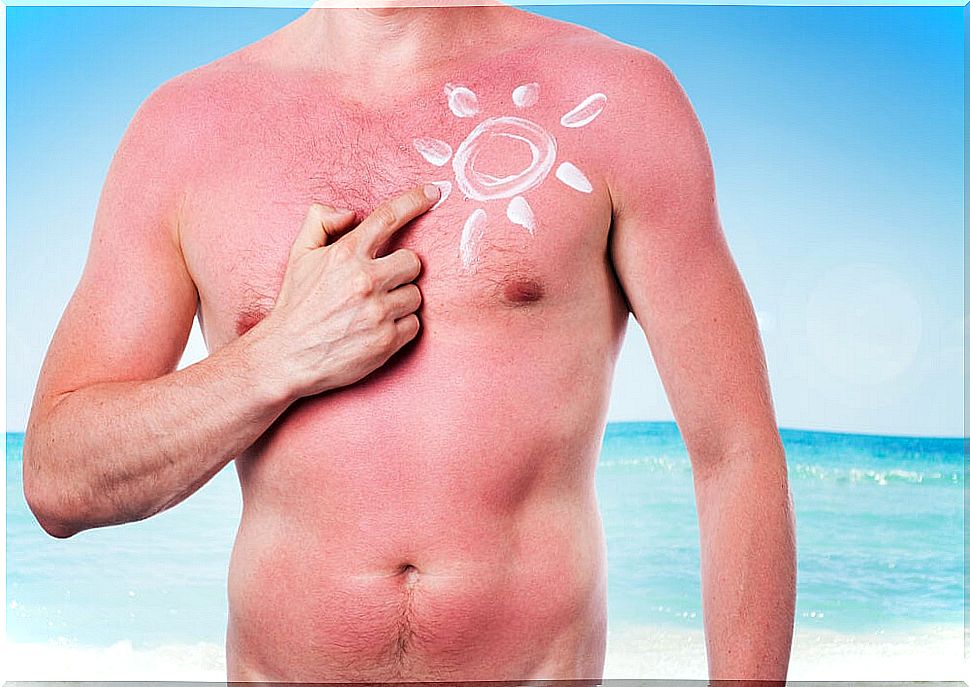 Man torso burned with sun-shaped cream.