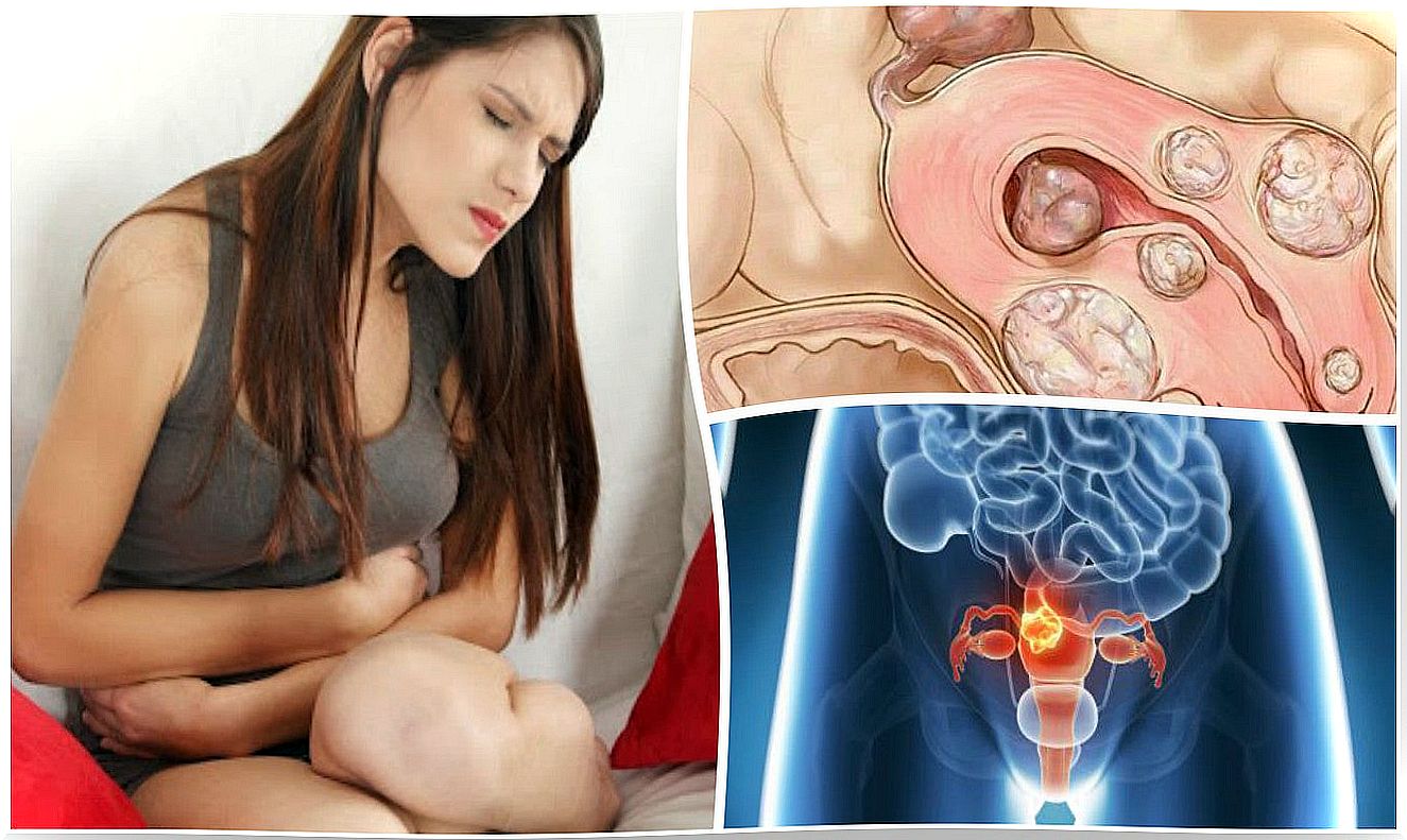 5 facts about uterine fibroids that every woman should know