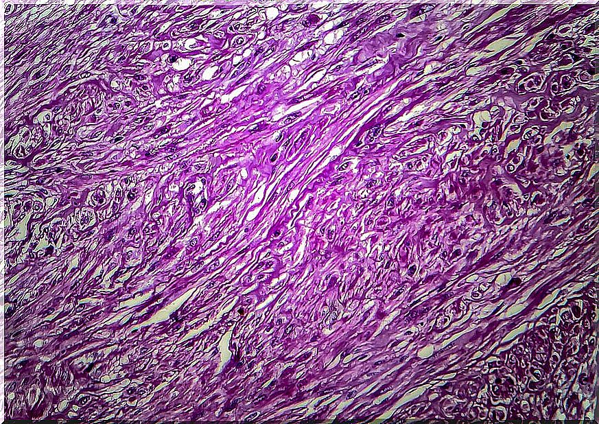 Microscopic view of uterine fibroids