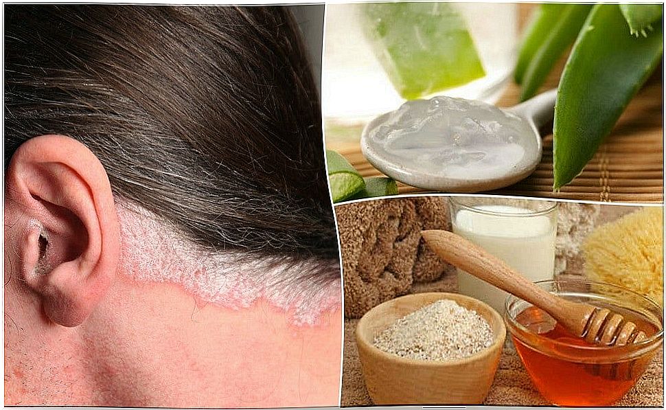 5 home remedies for psoriasis on the scalp