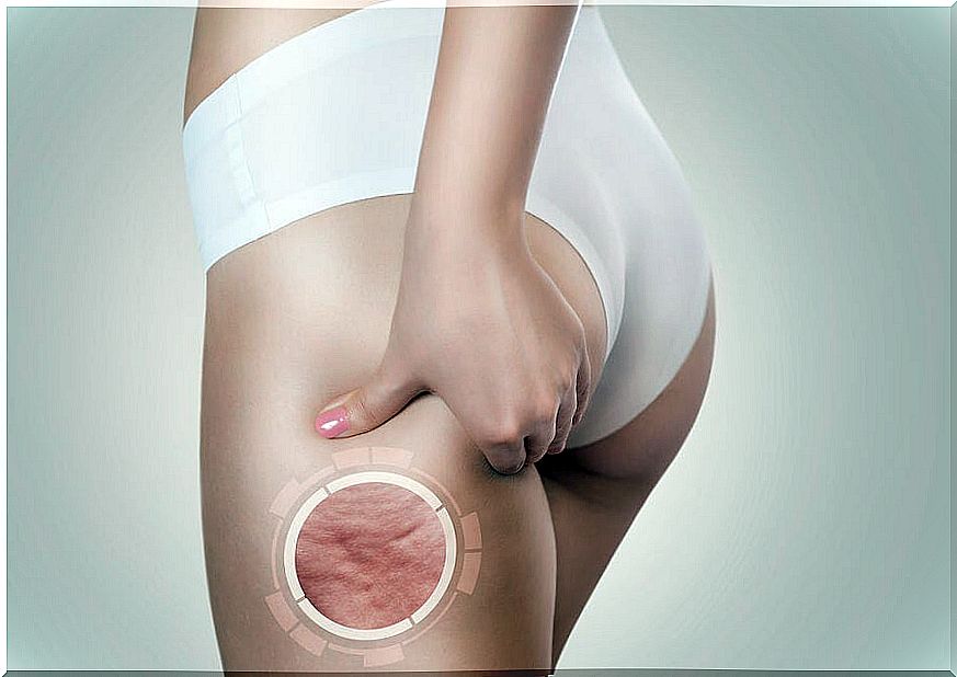 What Causes Cellulite?