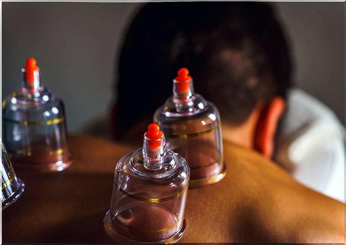 Cupping or cupping massage: what does it consist of?