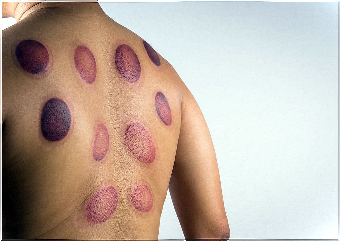 Cupping back injuries.