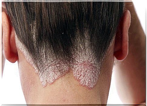 Home remedies for dandruff and seborrhea