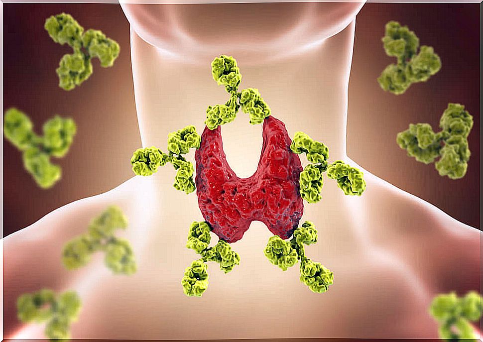 Hypothyroidism: causes, symptoms, diagnosis and treatment