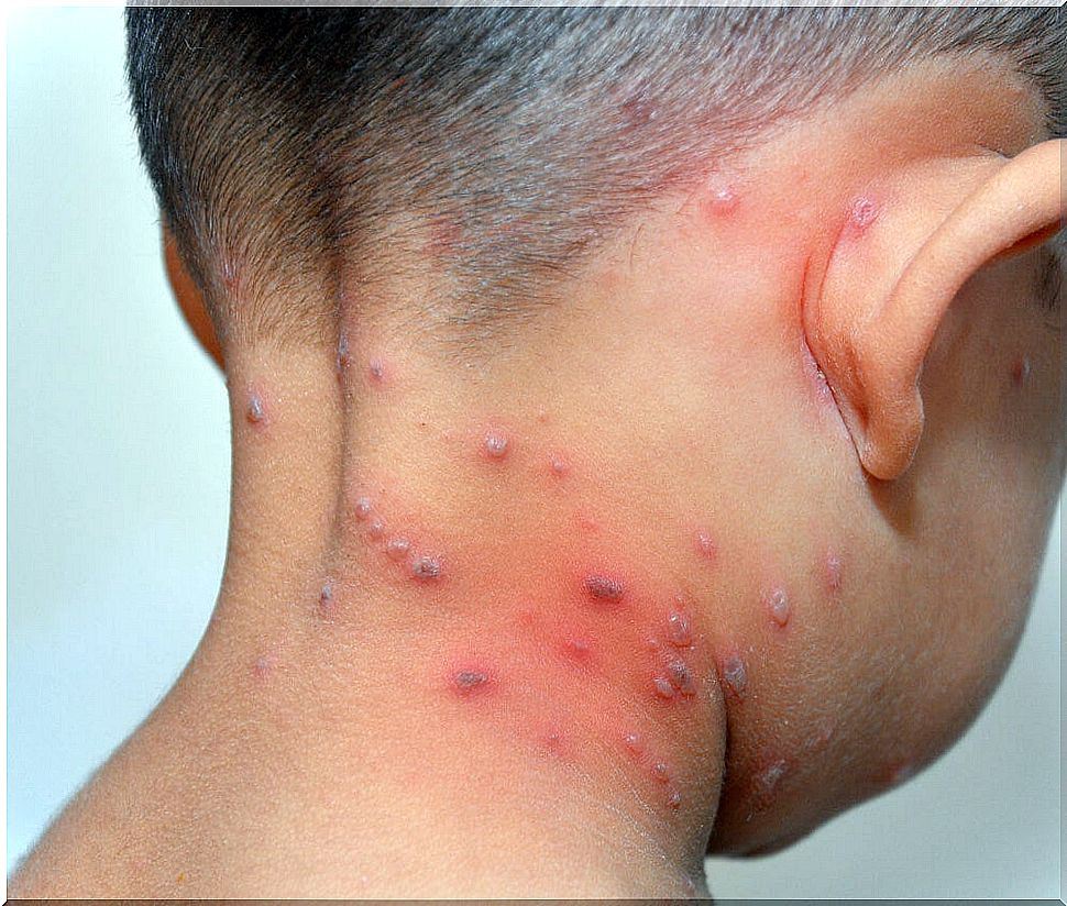 Child with chickenpox