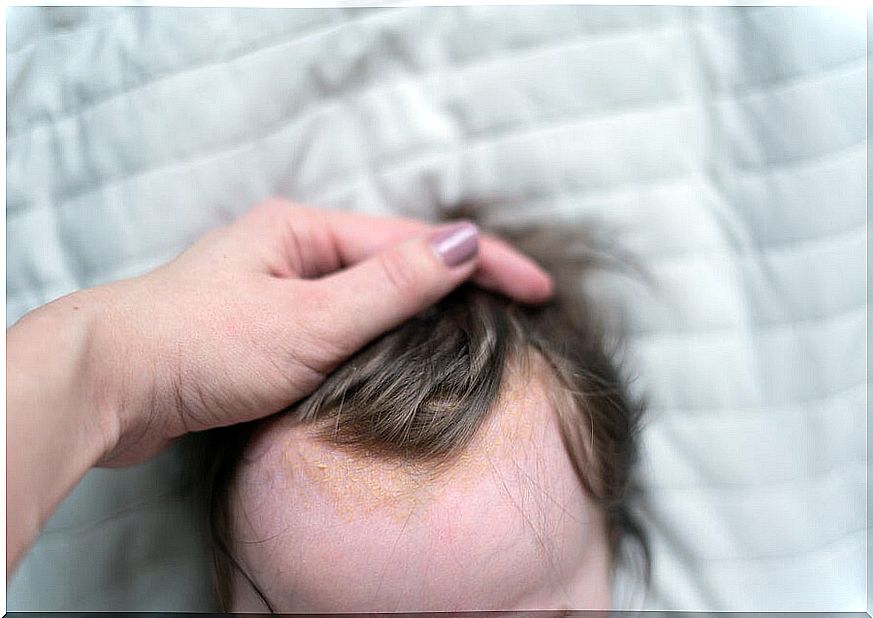 Cradle cap, one of the common irritations on baby's skin