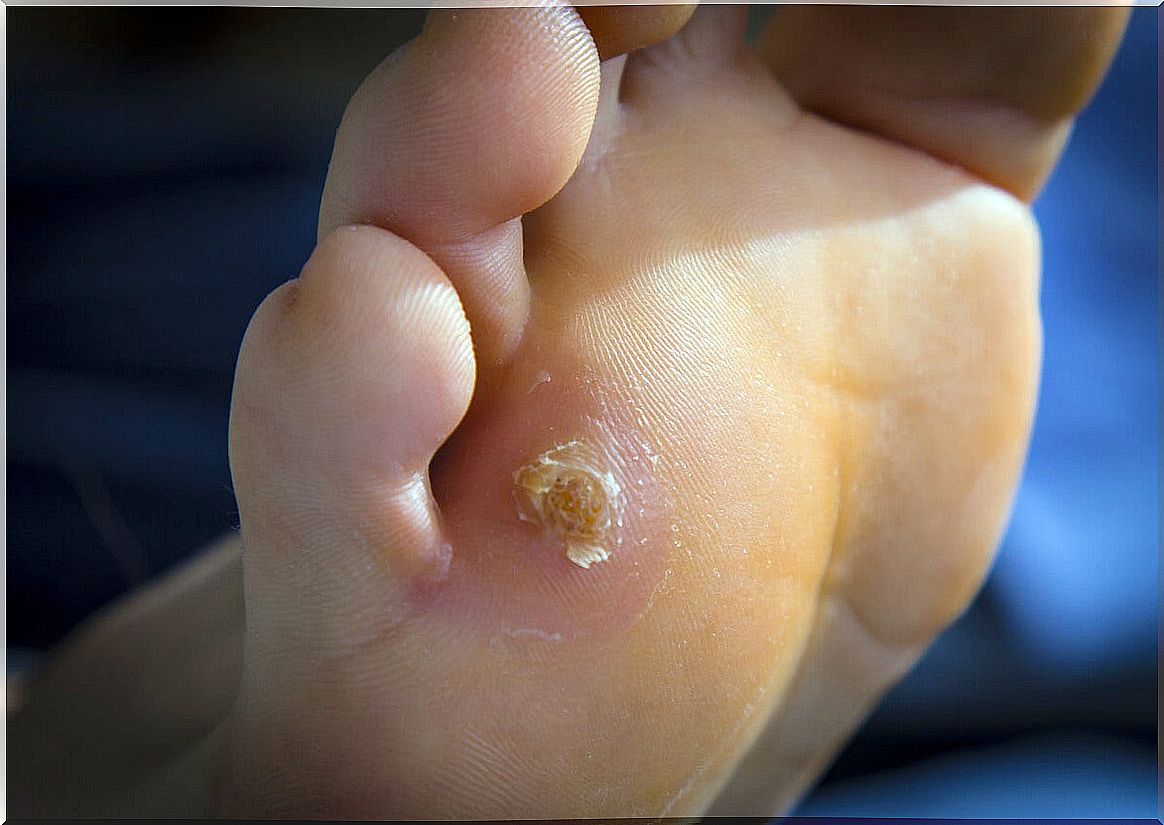 Plantar callus.